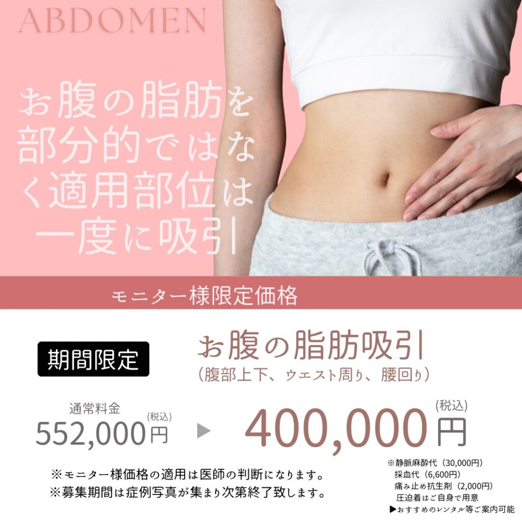 お腹全体(上腹・下腹・ウエスト・腰)の脂肪吸引のモニター募集をする画像