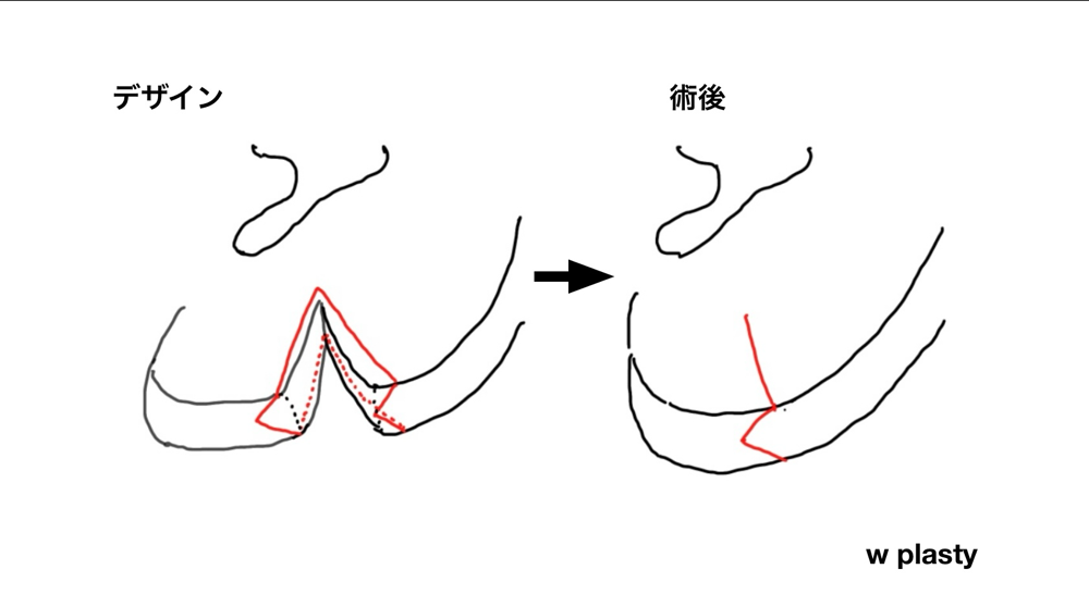 耳垂裂に対するw形成術