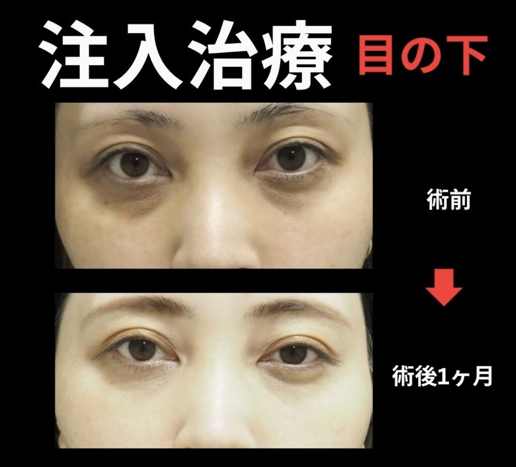 目の下クマに対する注入治療