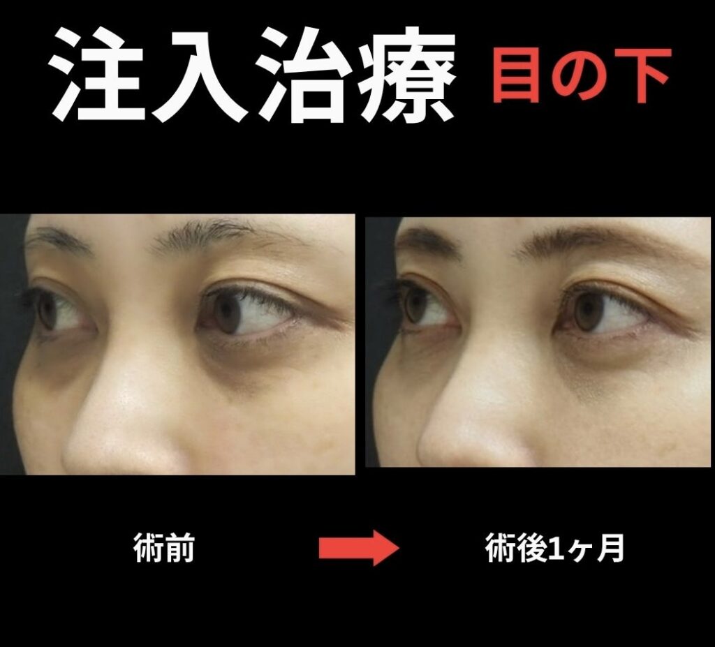 目の下クマに対する注入治療