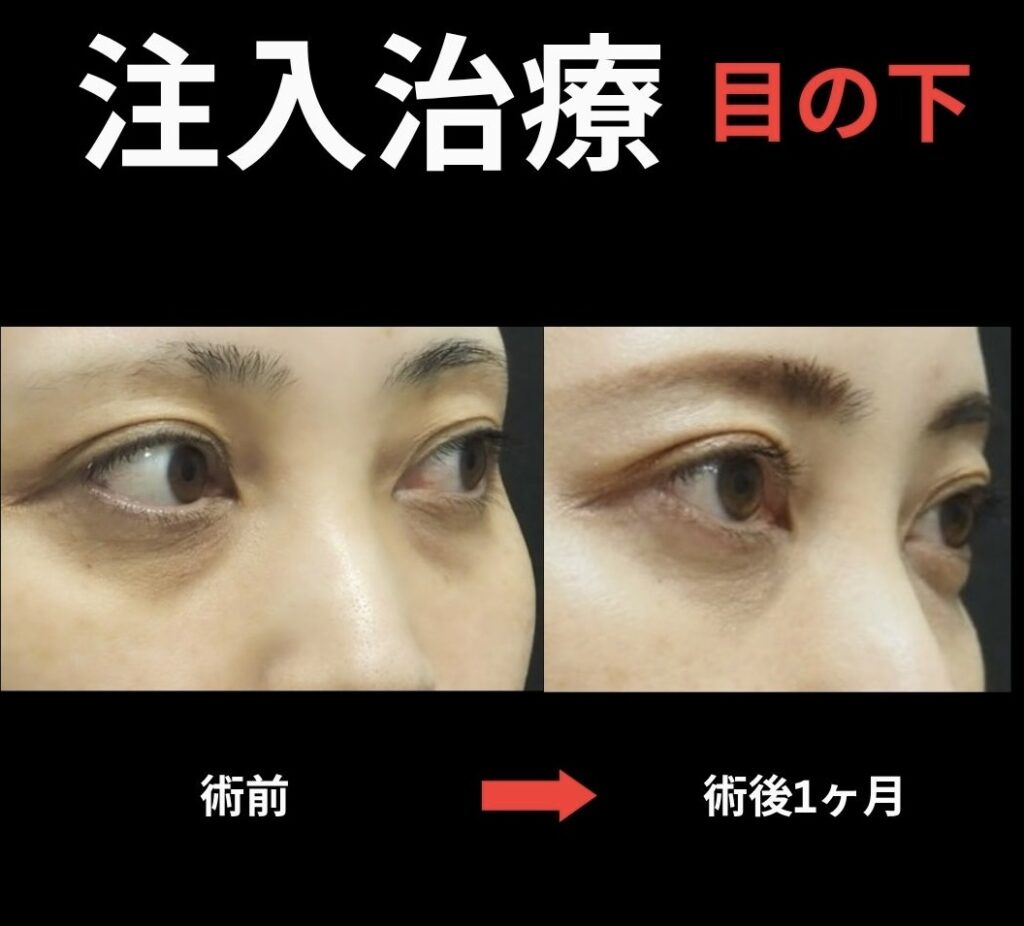 目の下クマに対する注入治療