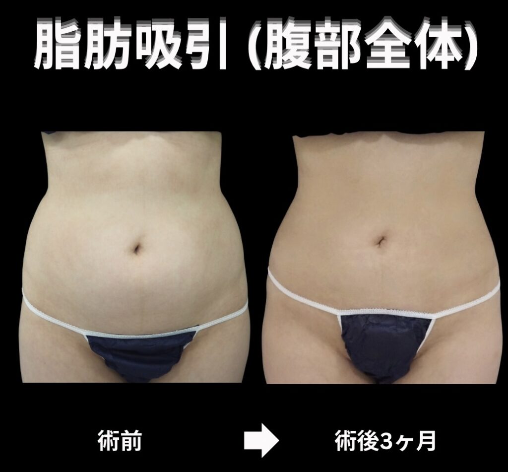腹部全体の脂肪吸引症例