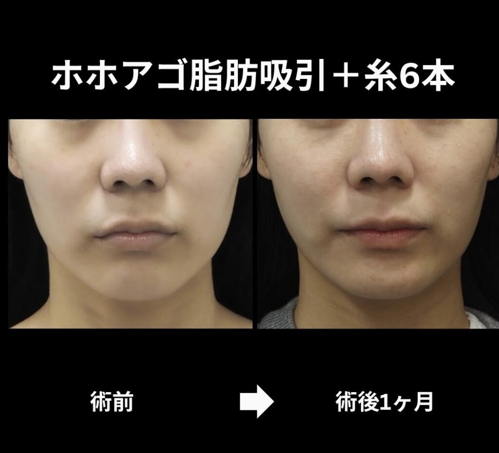 サクションリフトの症例写真