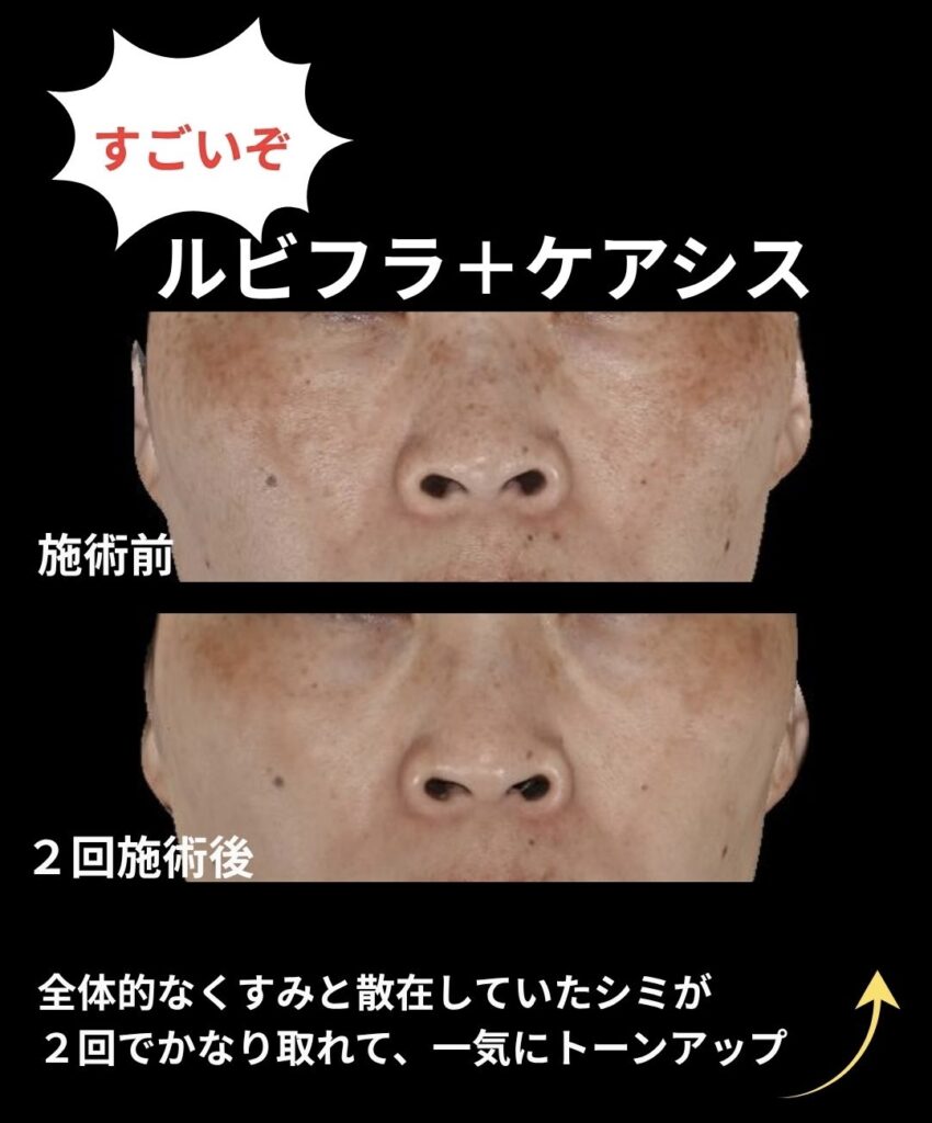 ルビーフラクショナルレーザーとケアシスの複合治療症例