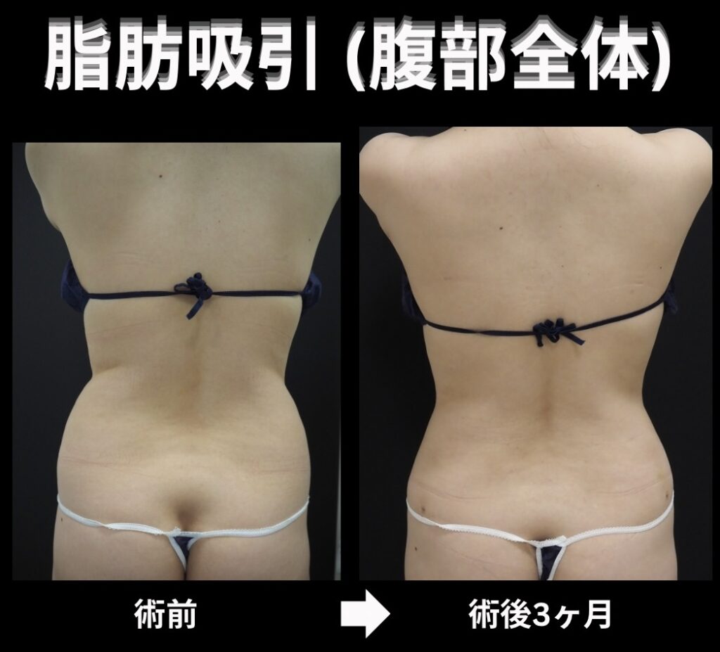 腹部全体の脂肪吸引症例