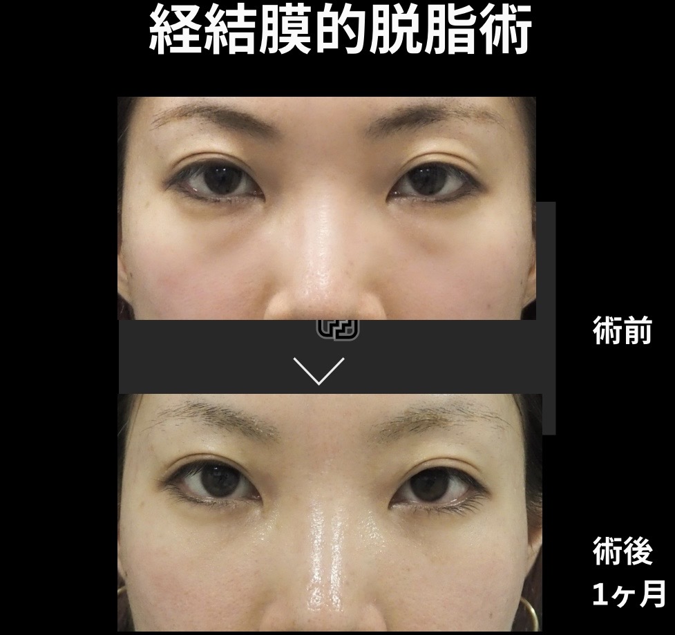 経結膜的脱脂術の症例写真