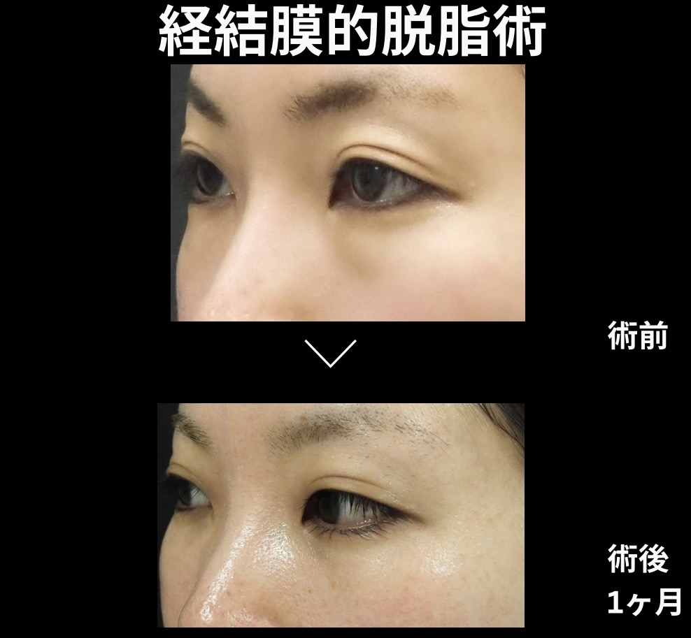 経結膜的脱脂術の症例写真