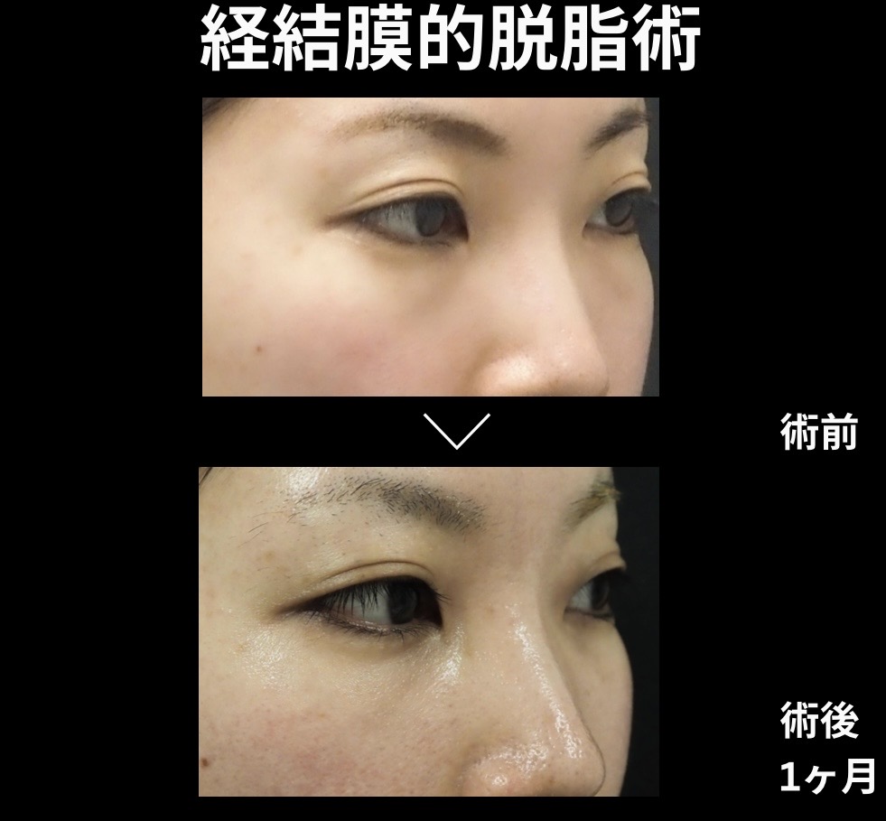 経結膜的脱脂術の症例写真