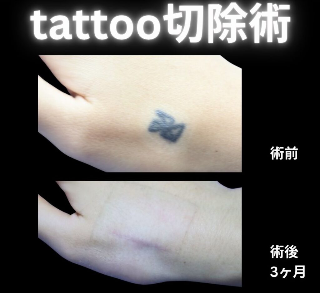 tattoo切除術