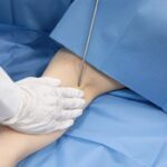 二の腕の脂肪吸引