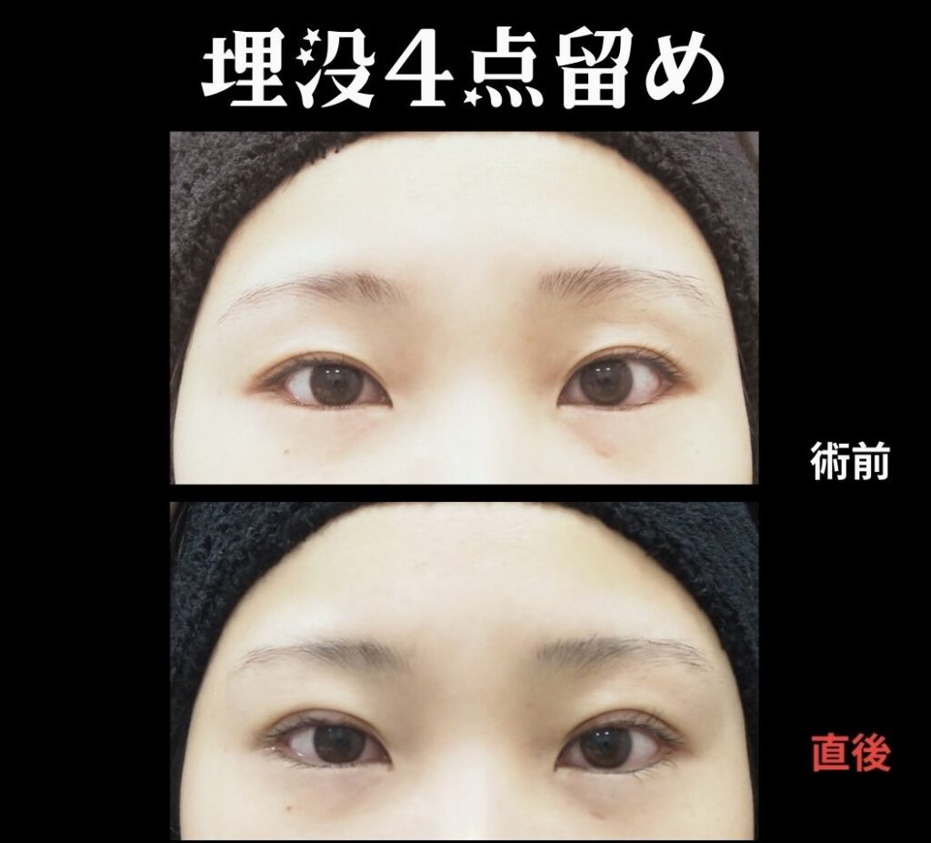 埋没法(挙筋法4点留め)の症例写真