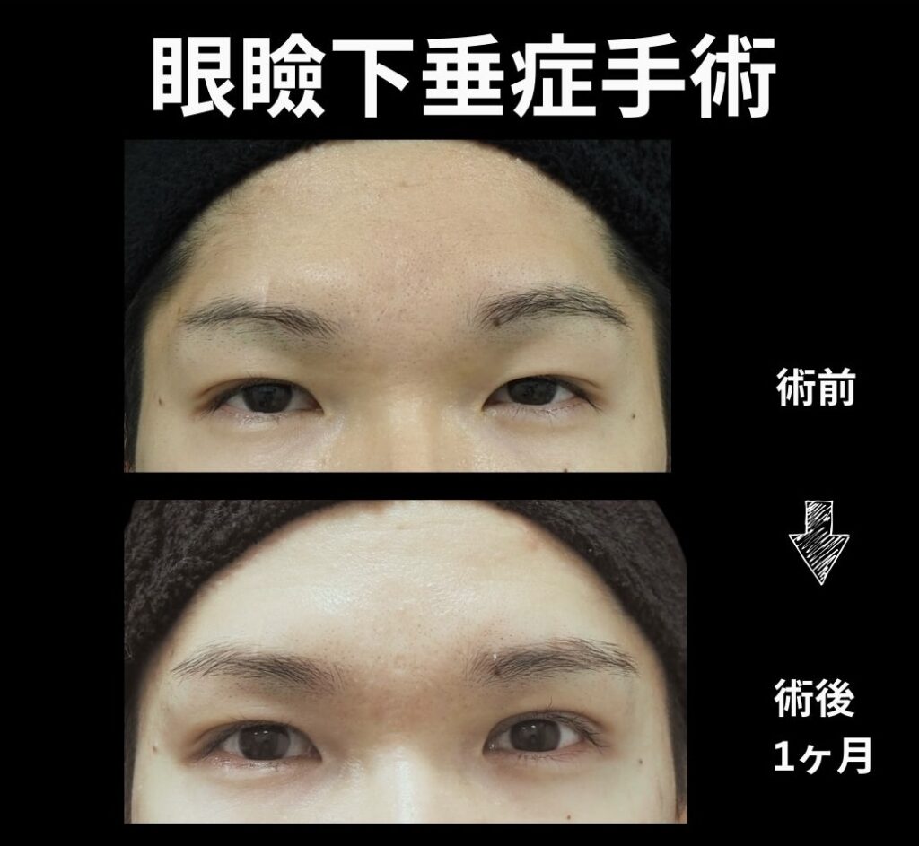 眼瞼下垂症手術(開瞼時)