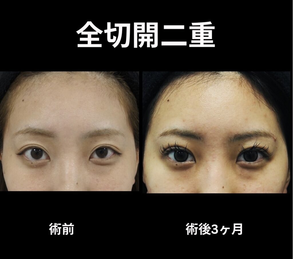 全切開二重術の症例写真