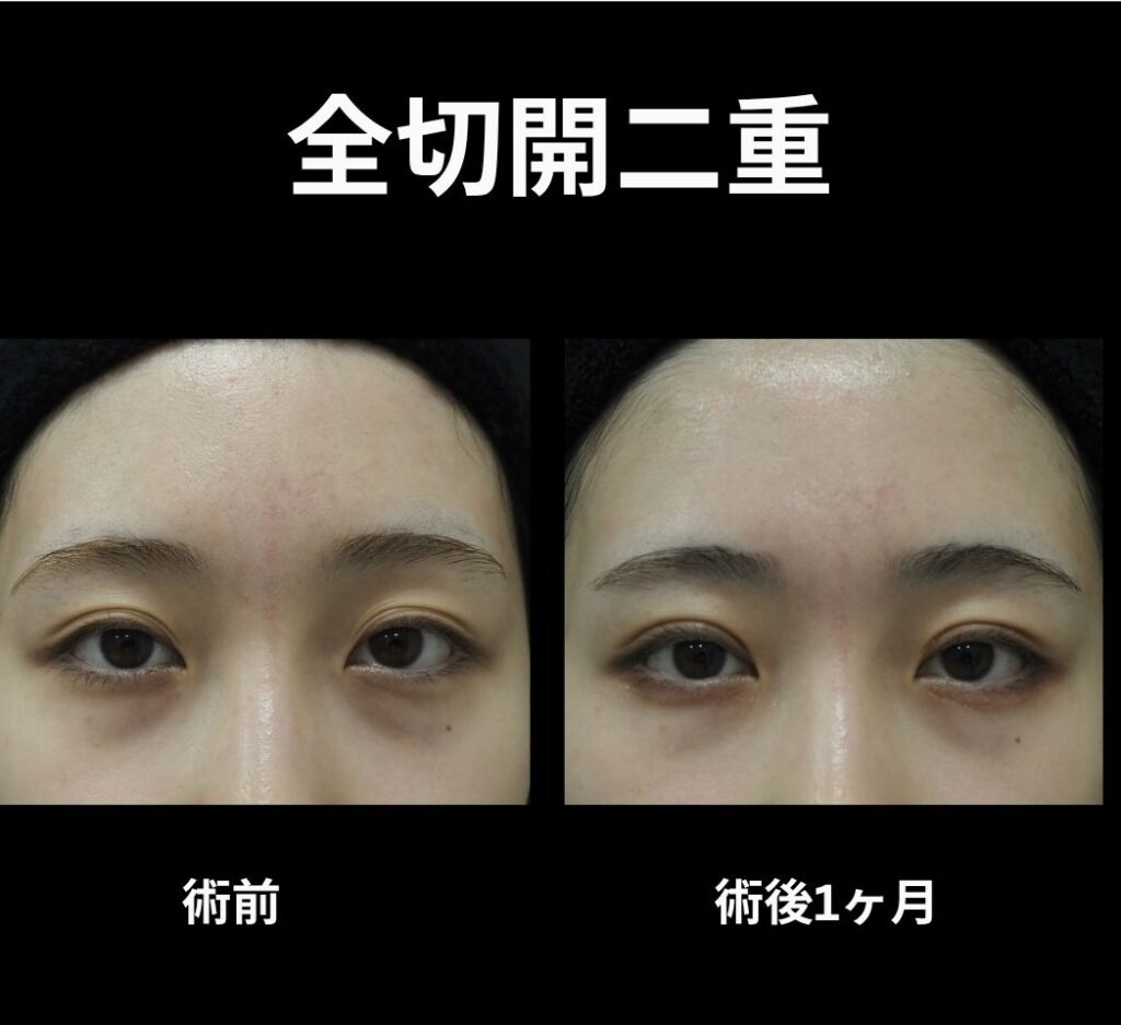 全切開二重の症例写真