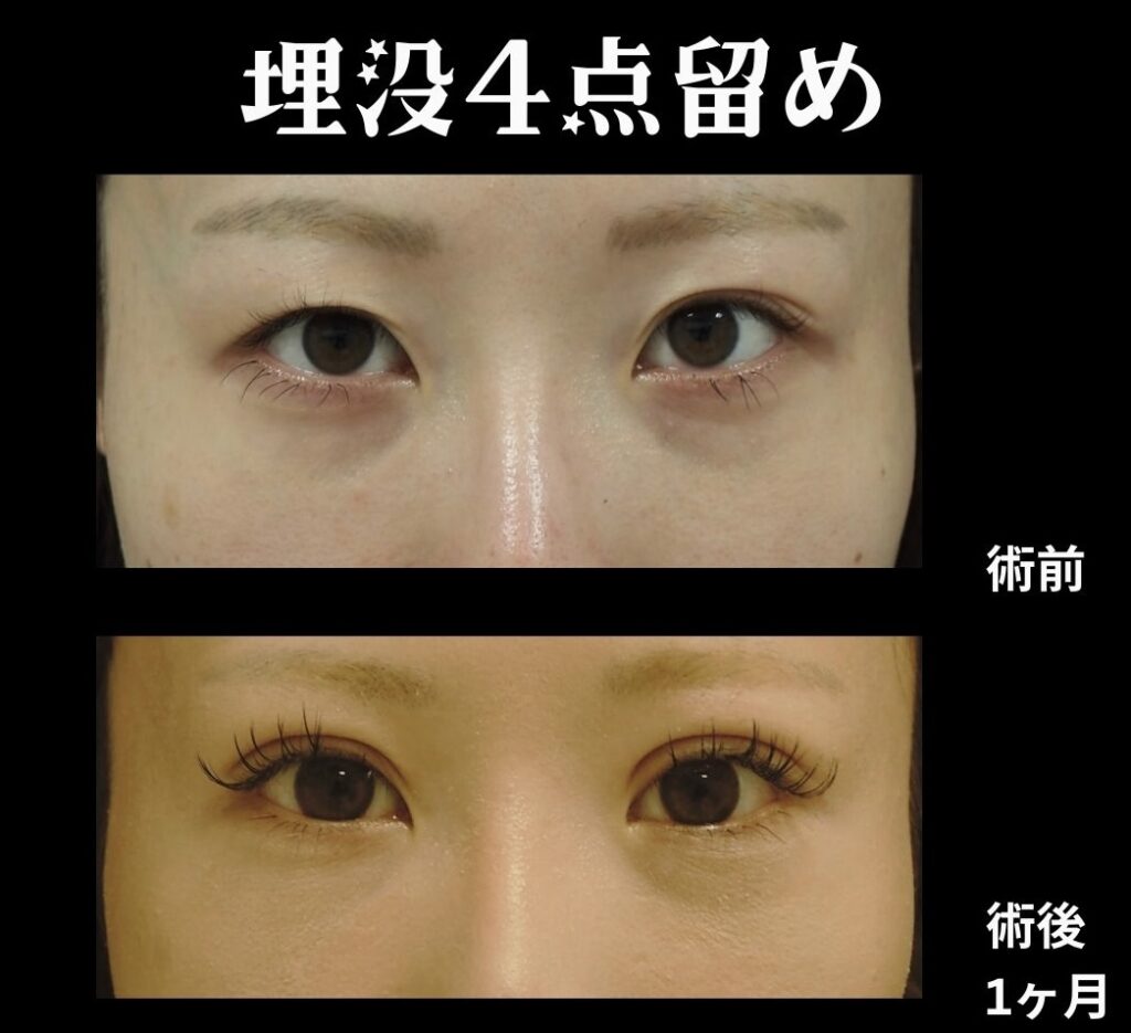埋没4点留めの症例写真