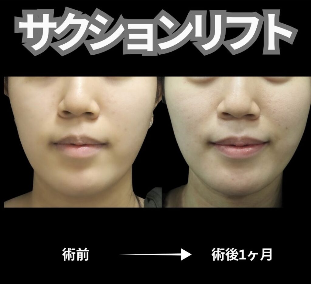 20代女性サクションリフトの術前術後写真