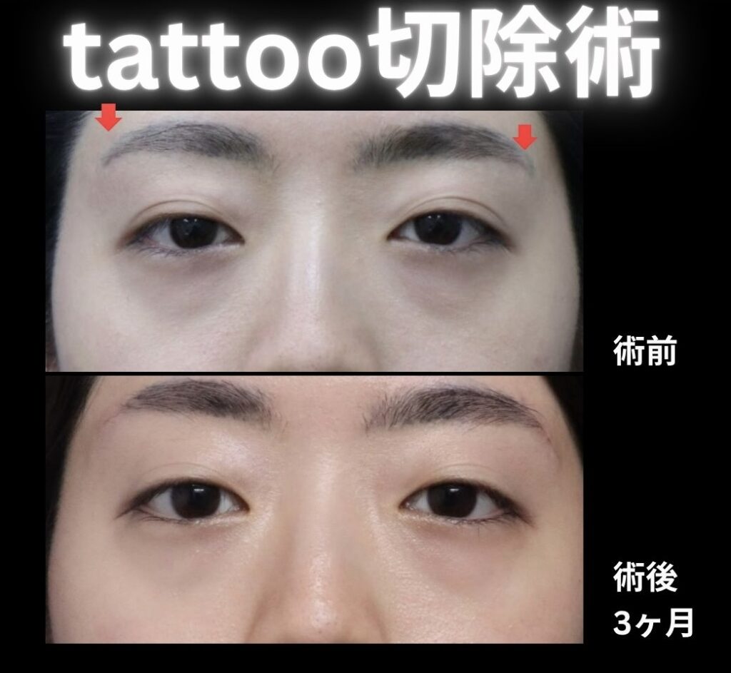 アートメイク除去