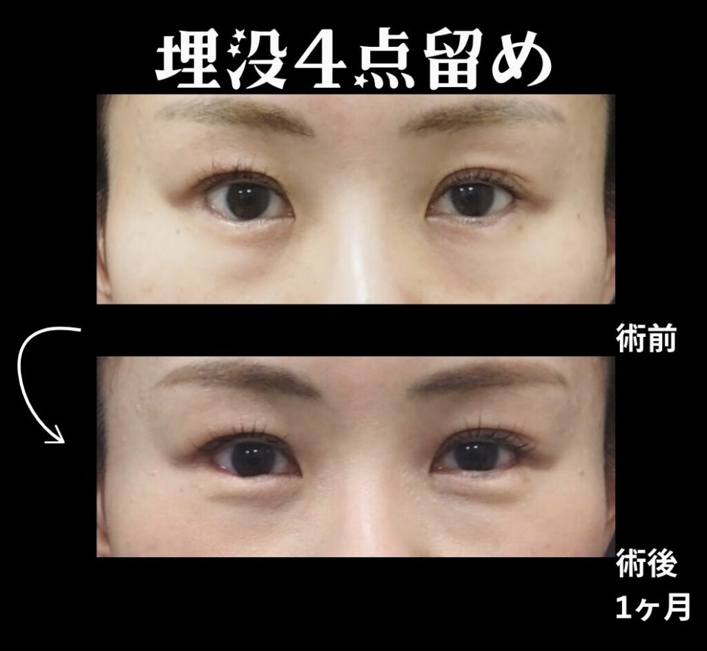 埋没挙筋法4点留め