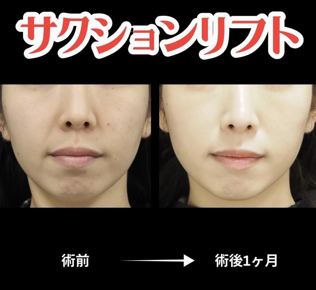 サクションリフトの術前術後比較写真