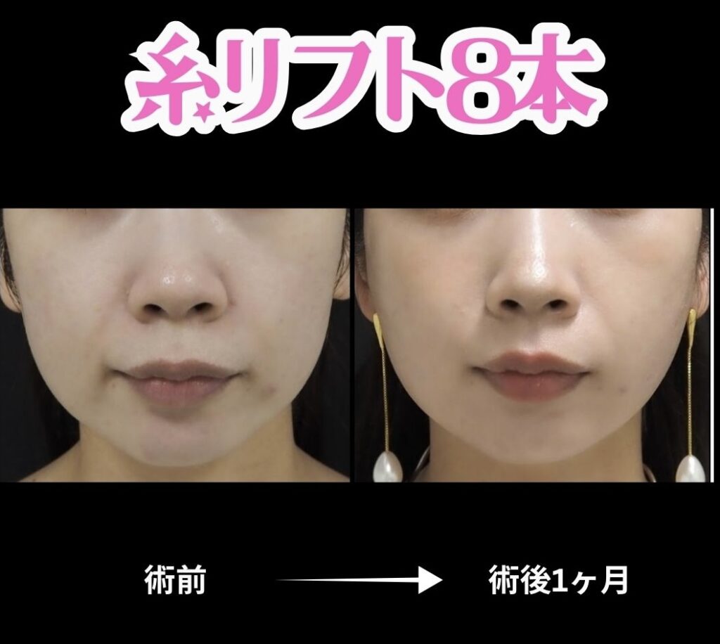 20代女性・糸リフト8本の症例写真