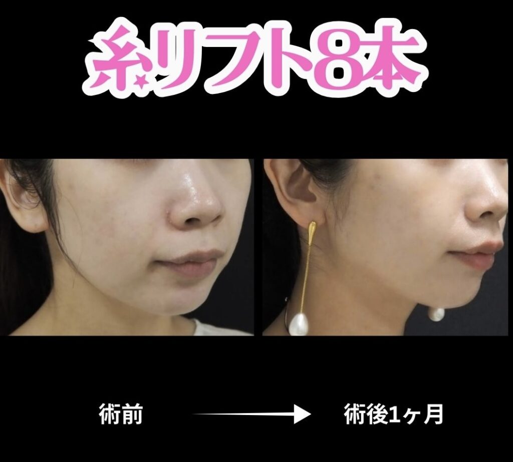 20代女性・糸リフト8本の症例写真