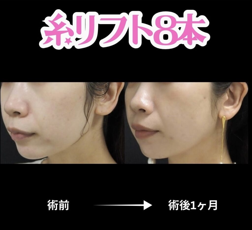 20代女性・糸リフト8本の症例写真