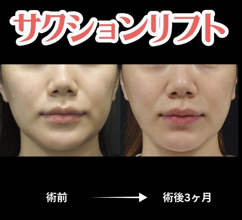 サクションリフトの症例写真