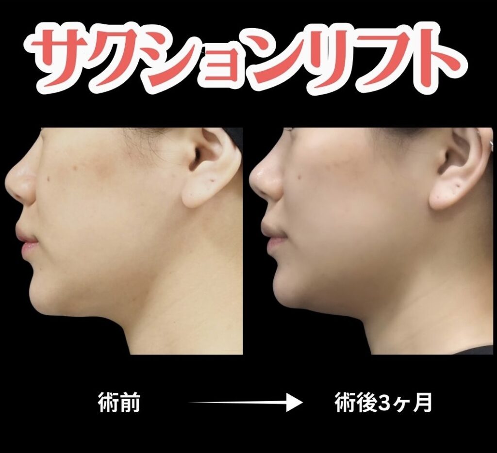 サクションリフトの症例写真