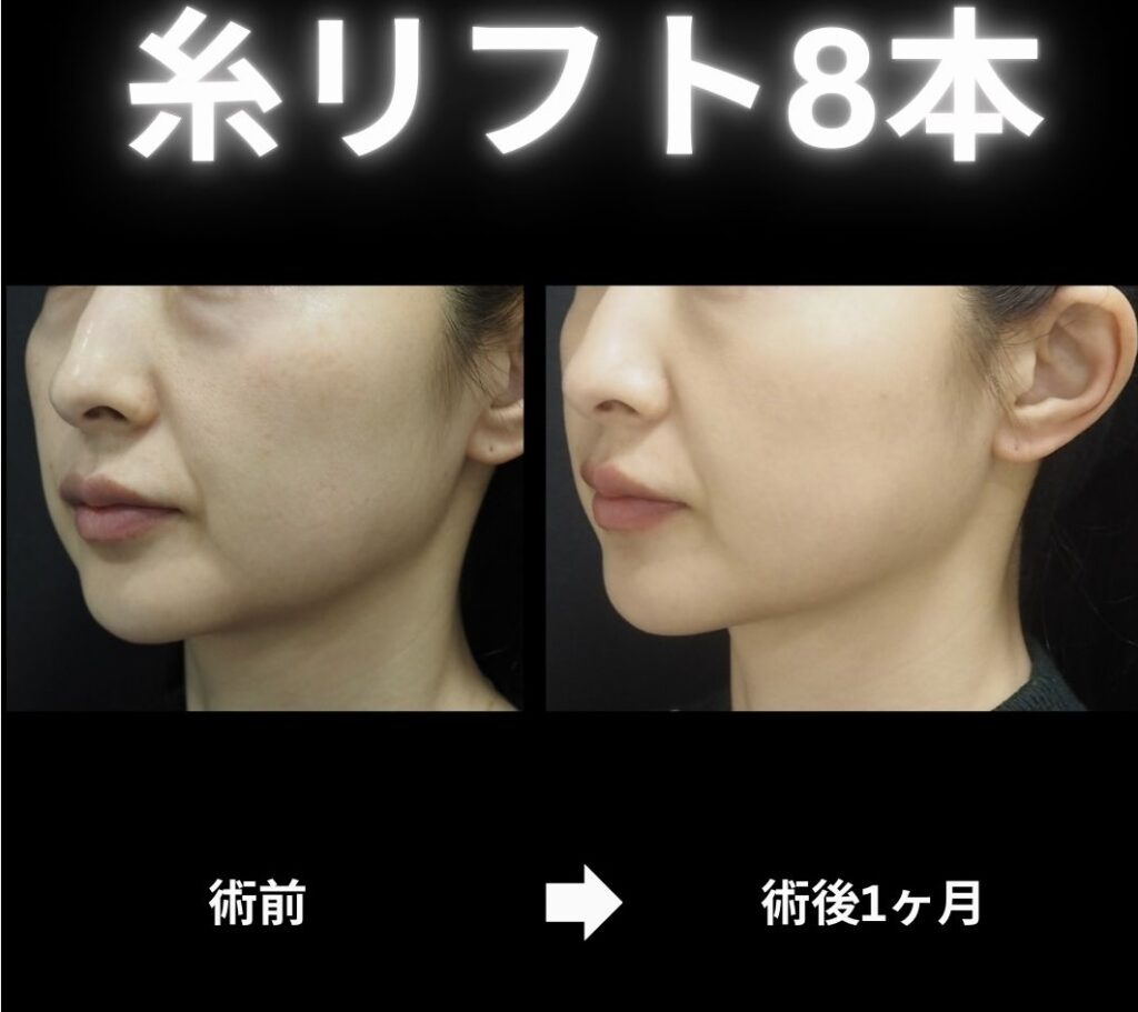 糸リフト8本の症例写真