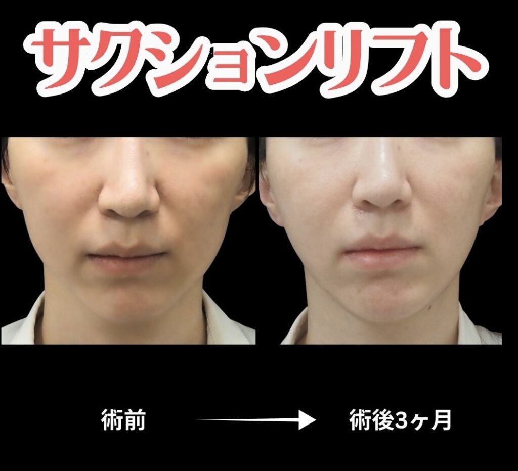 サクションリフトの症例写真