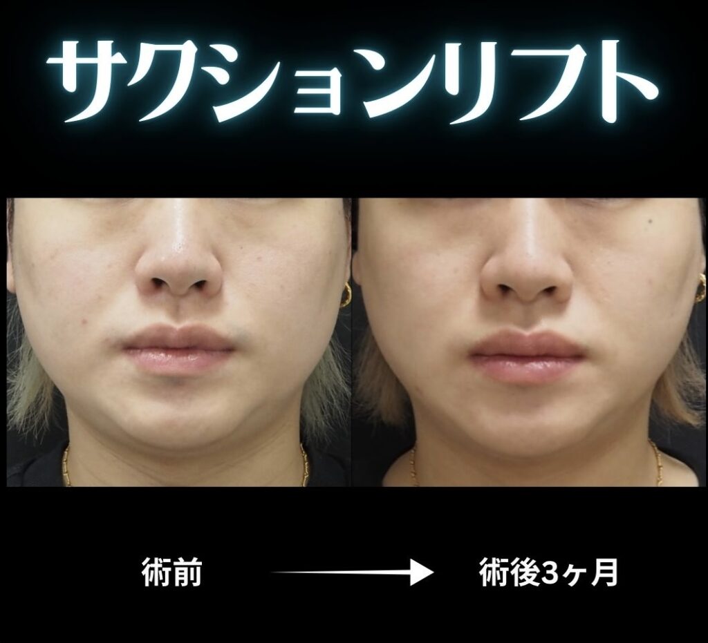 メンズサクションリフトの症例写真