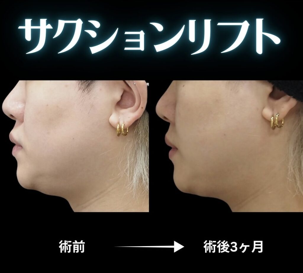 メンズサクションリフトの症例写真