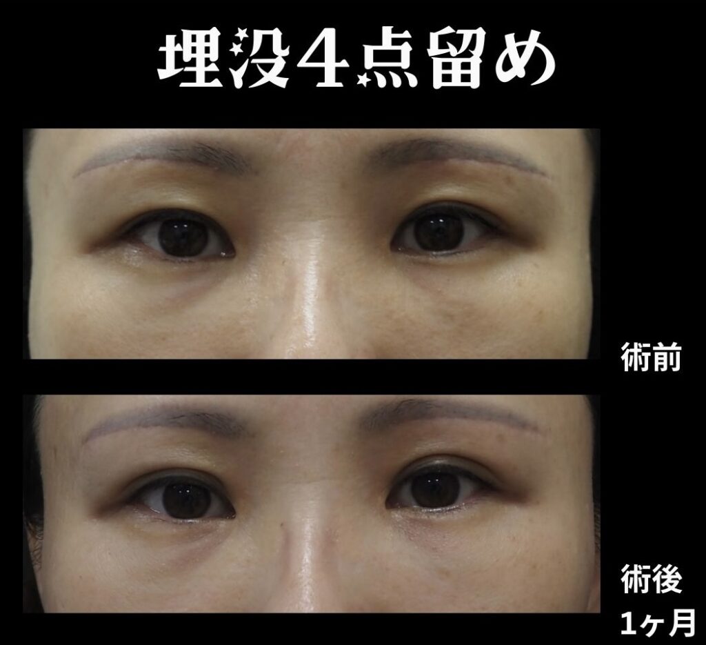 埋没法(挙筋4点法)の症例写真