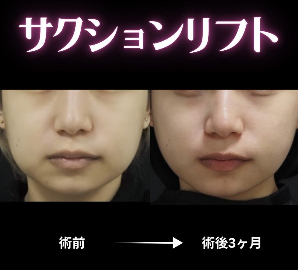 サクションリフトの症例写真