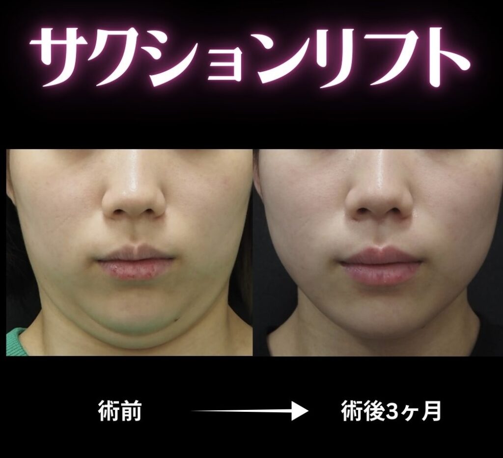 サクションリフトの症例写真