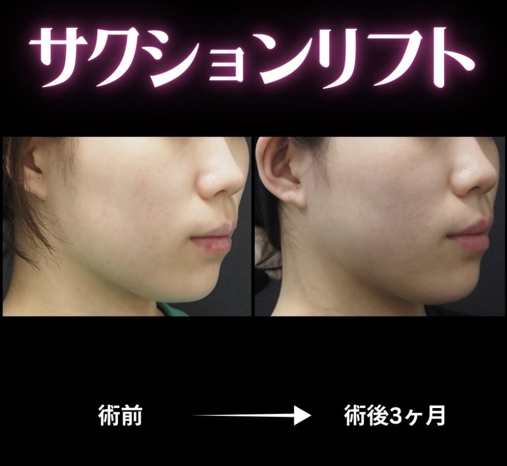 サクションリフトの症例写真
