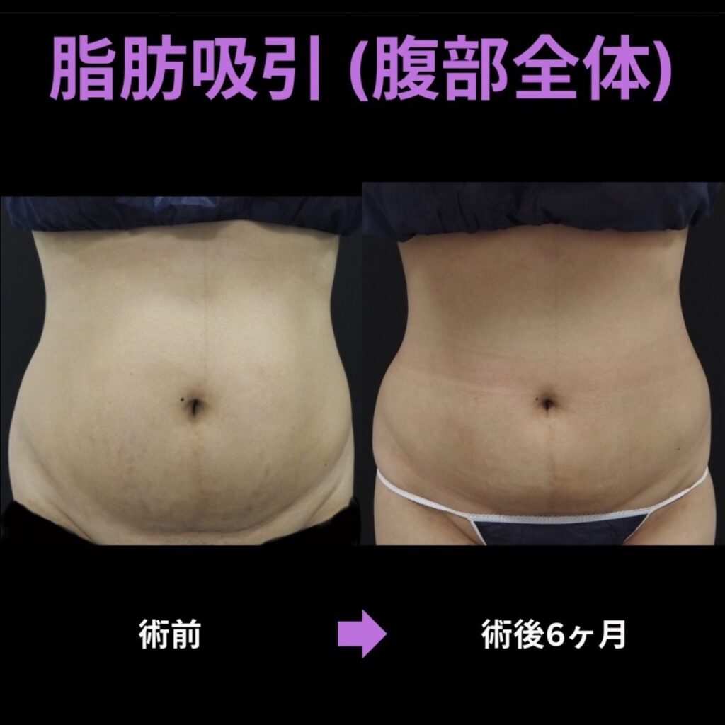 腹部全体の脂肪吸引症例