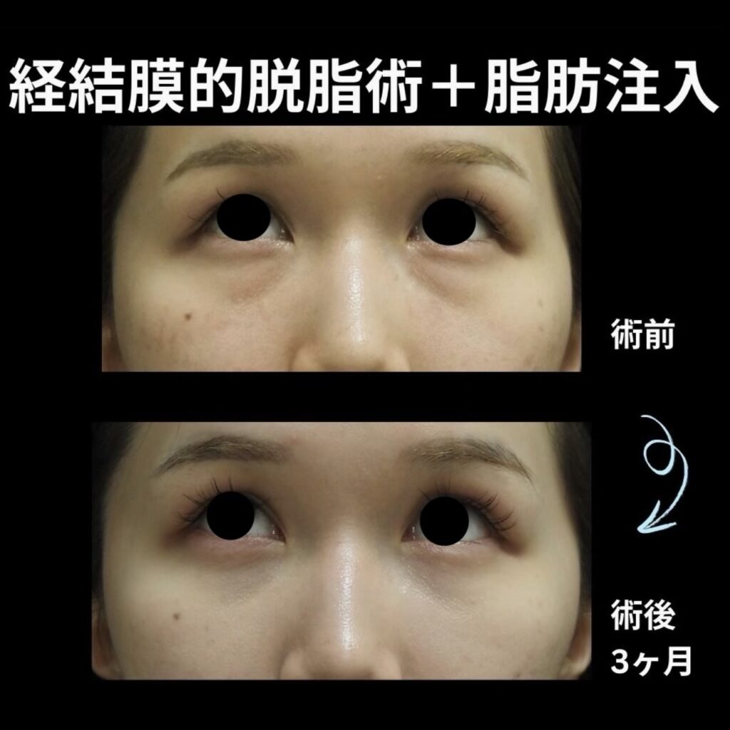 経結膜的脱脂術+脂肪注入(目の下)の症例写真