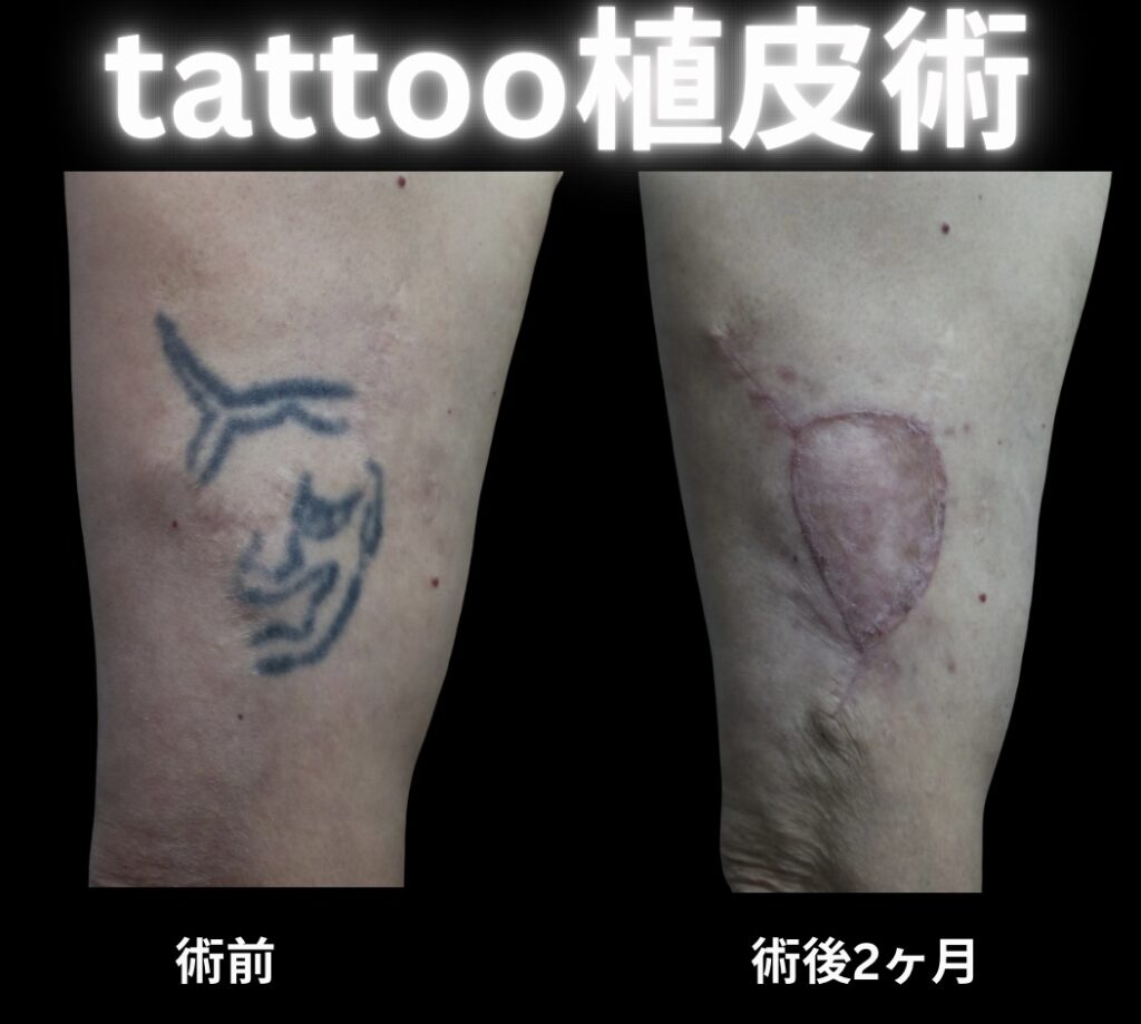 tattoo植皮の症例写真