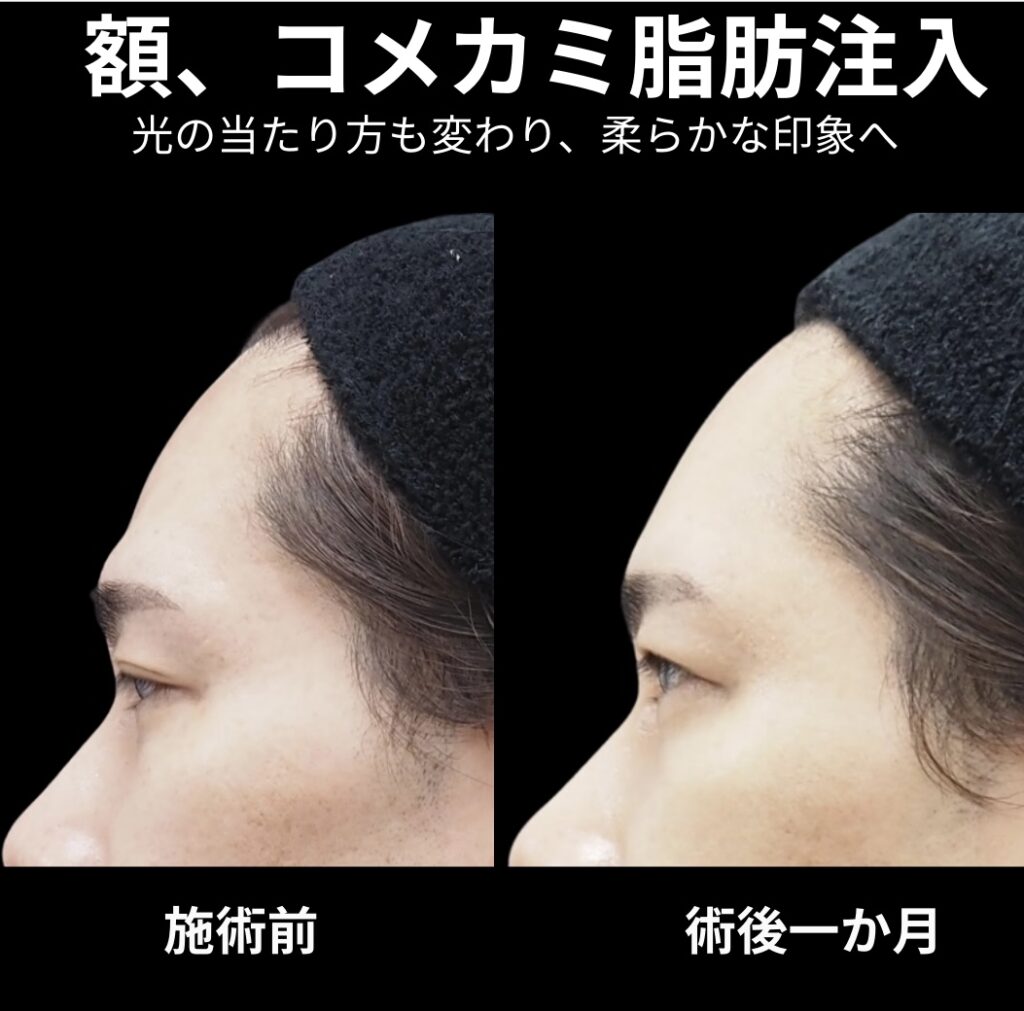 額・こめかみの脂肪注入に関する症例写真