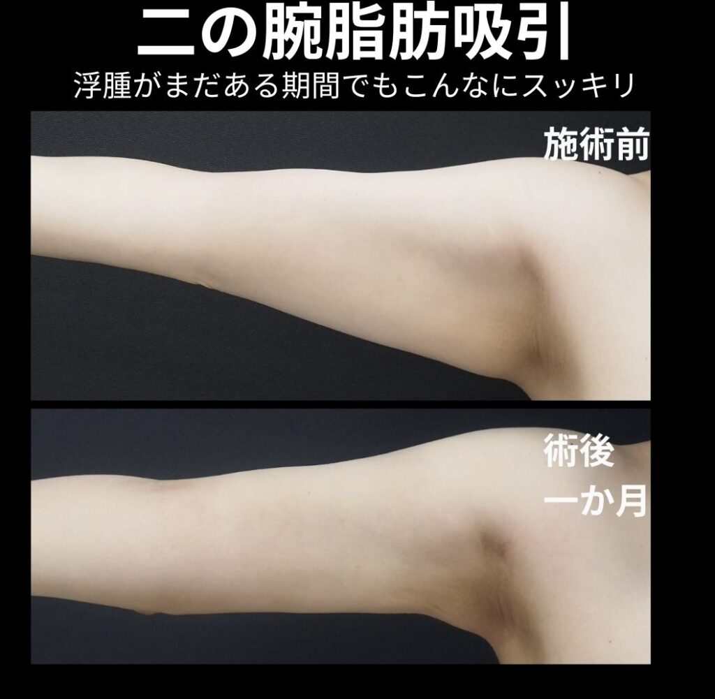 二の腕全体脂肪吸引の症例写真