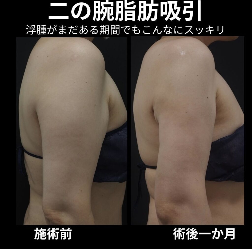 二の腕全体脂肪吸引の症例写真