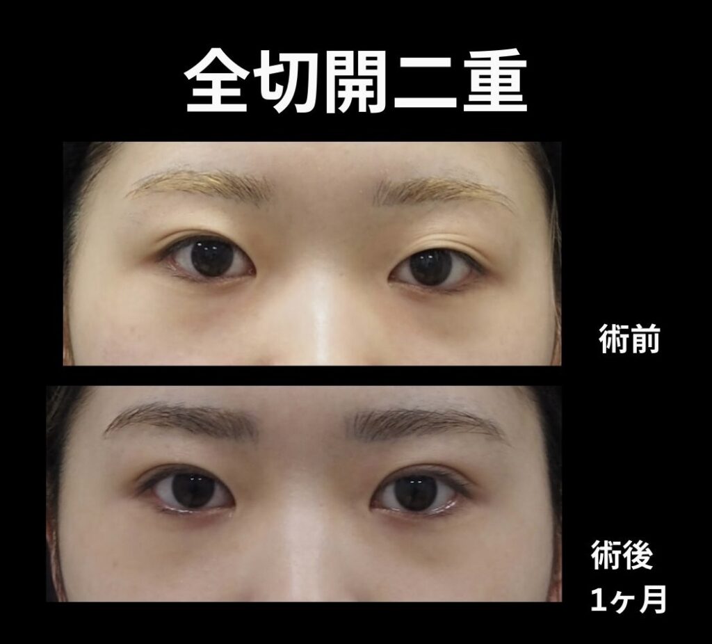 全切開二重術の術前後写真
