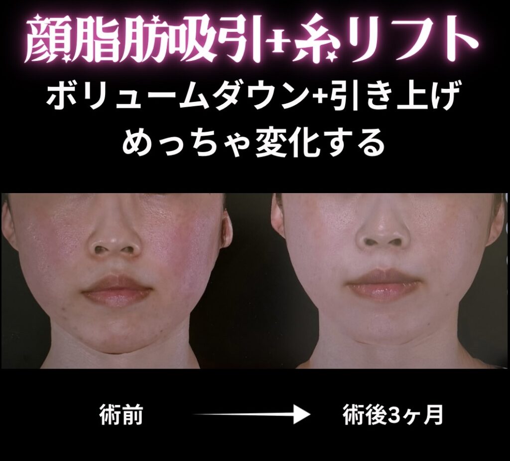 顔脂肪吸引＋糸リフトの症例写真