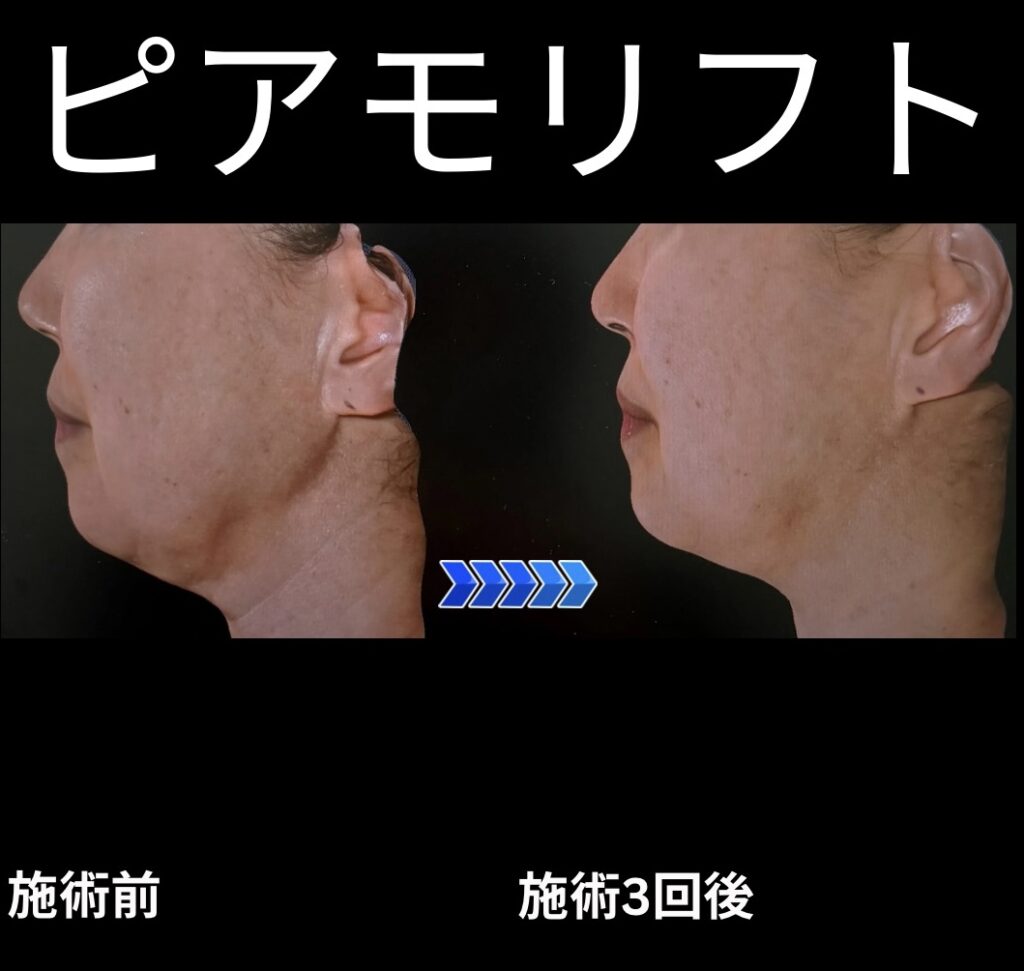 ピアモリフトの症例写真