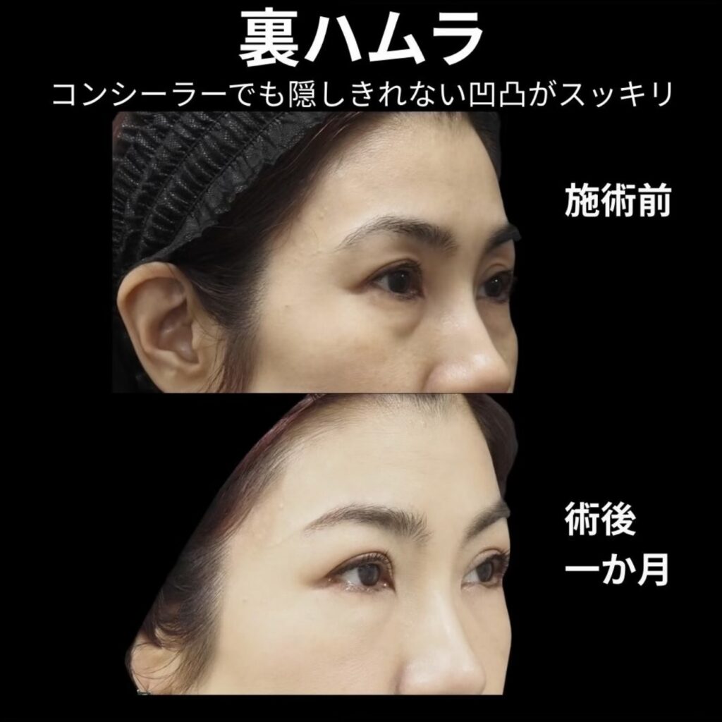 裏ハムラ法の術後１ヶ月写真