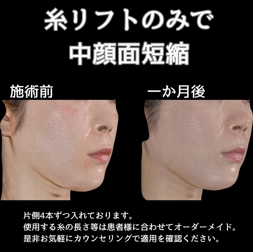 糸リフトの症例写真