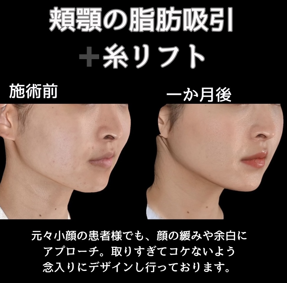 頬顎の脂肪吸引＋糸リフトの症例写真