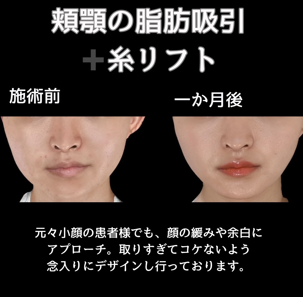 頬顎の脂肪吸引＋糸リフトの症例写真