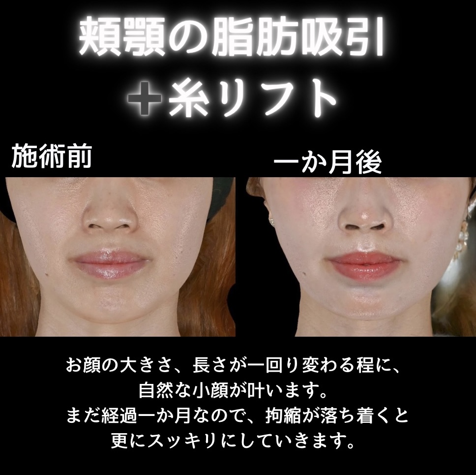 頬顎の脂肪吸引＋糸リフトの症例写真